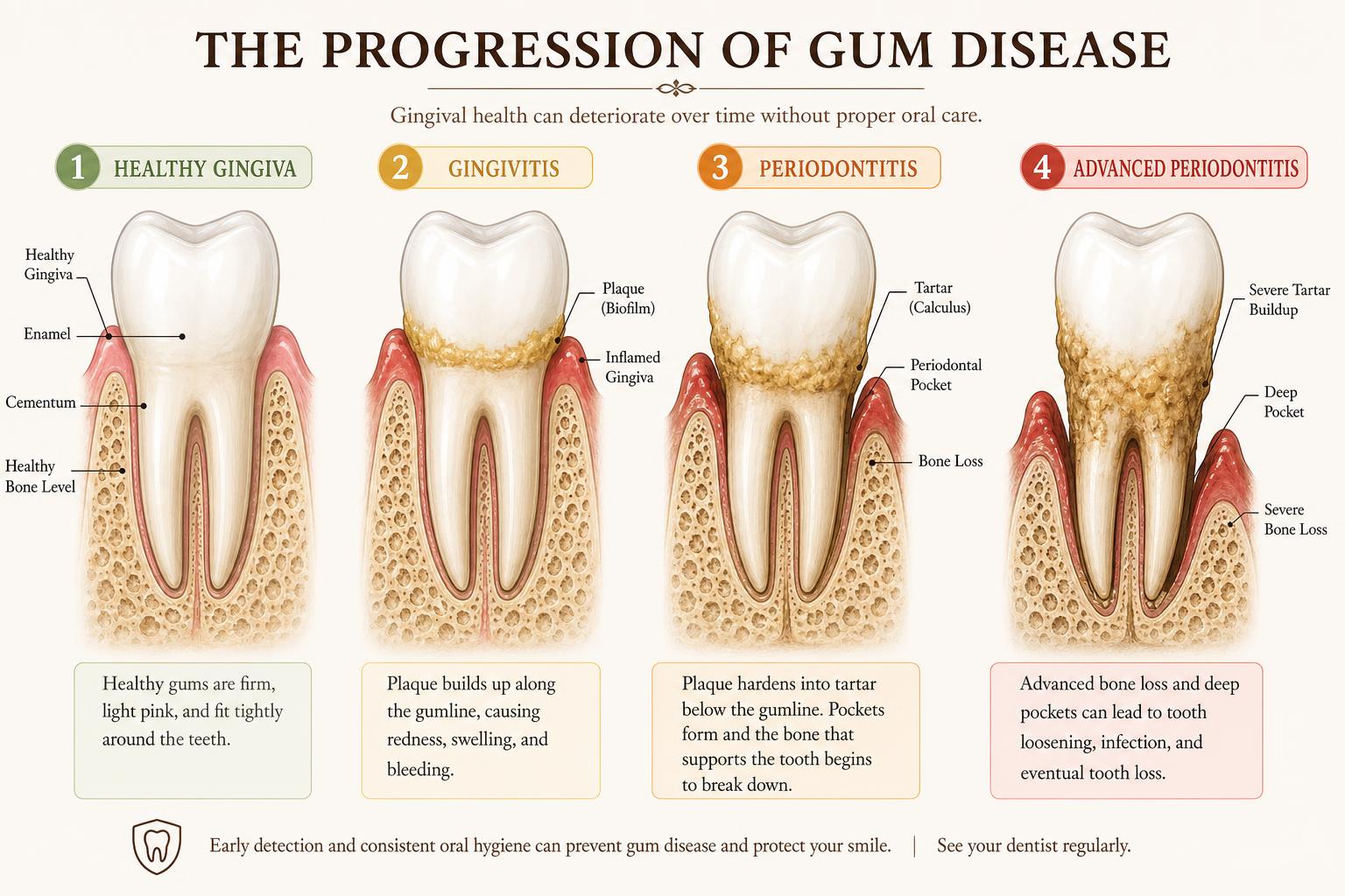 Progression of gum disease — biological diagram
